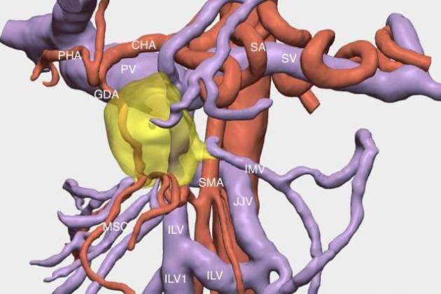Bellvitge reconstrucció tumor en tres dimensions Cella Medical Solutions Bellvitge reconstrucció tumor en tres dimensions Cella Medical Solutions