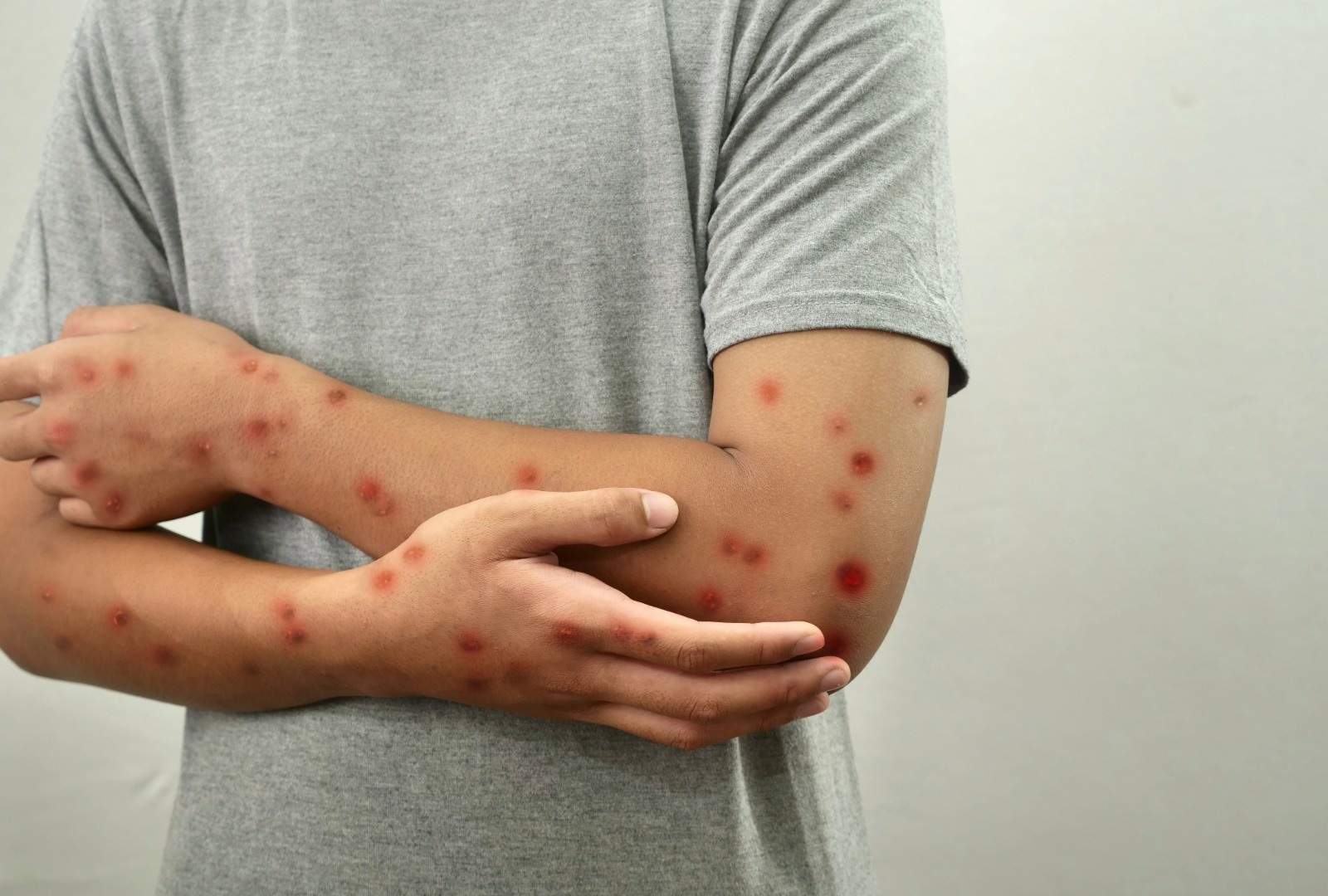 La recomanació de Sanitat davant l'alarmant explosió global de casos de xarampió