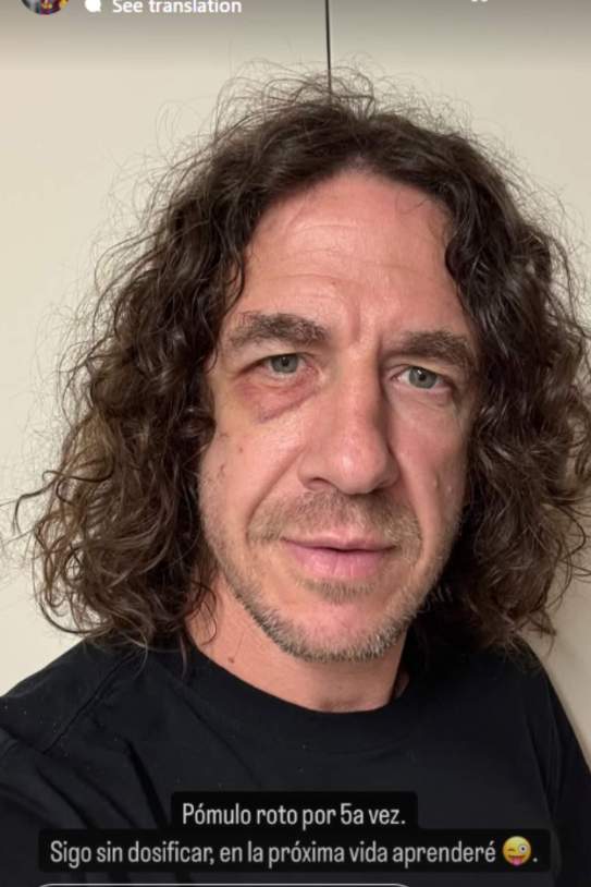 Carles Puyol amb el pòmul trencat / Instagram Carles Puyol amb el pòmul trencat / Instagram