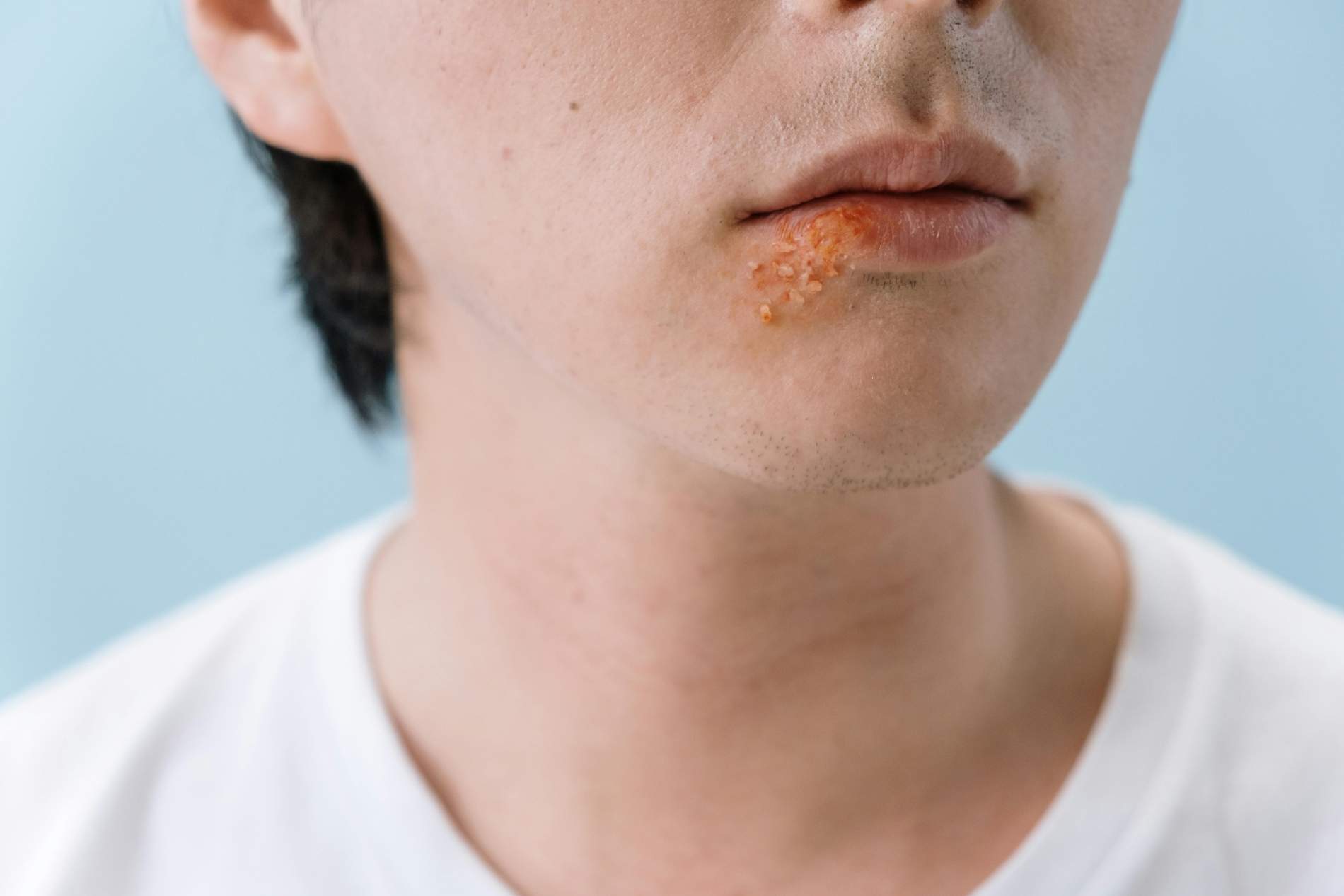 herpes labial cottonbro studio