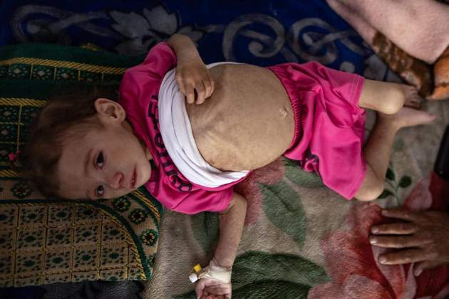 malnutricio gaza efe malnutricio gaza efe