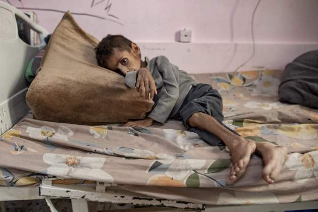 malnutricio gaza efe (2) malnutricio gaza efe (2)