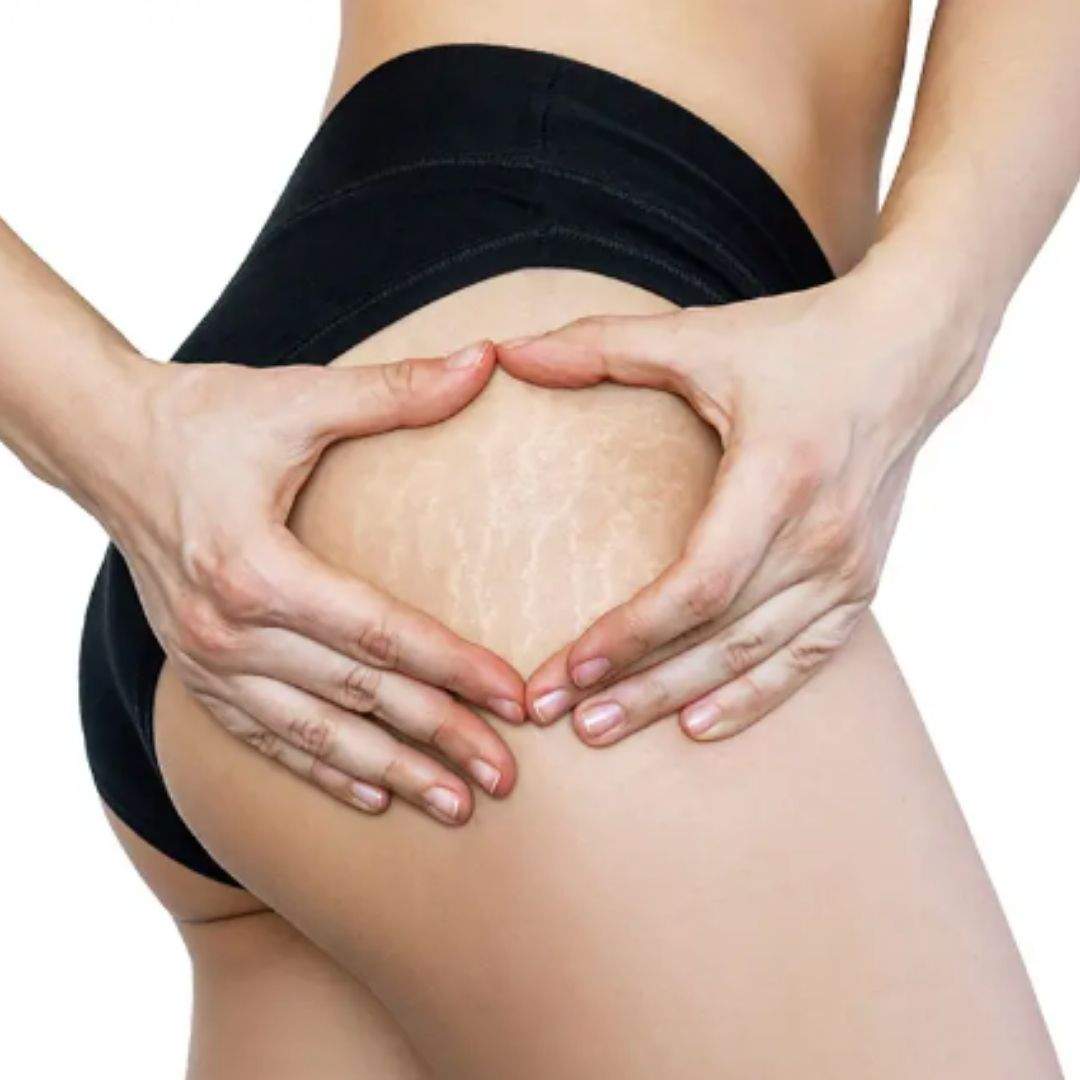 Reafirma, previene y suaviza: así actúa la crema Trofolastin que recomiendan los dermatólogos
