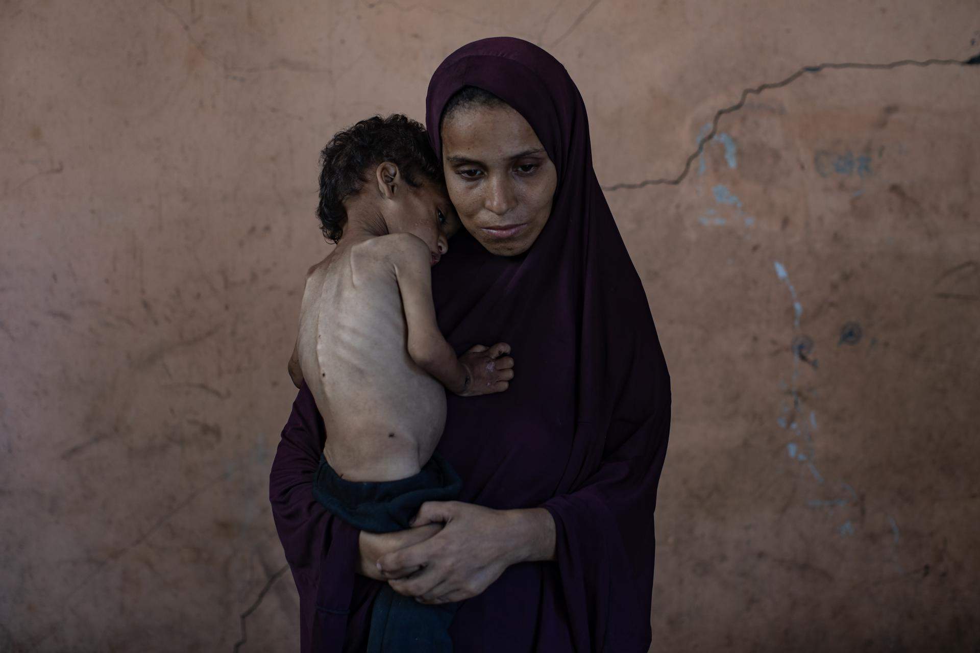 5. nen gaza desnutrició