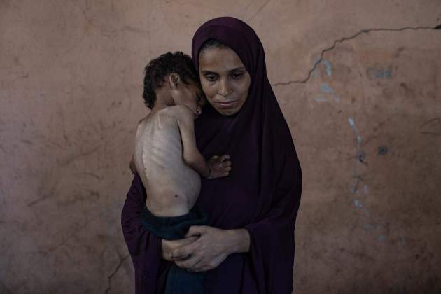5. niño gaza desnutrición 5. niño gaza desnutrición