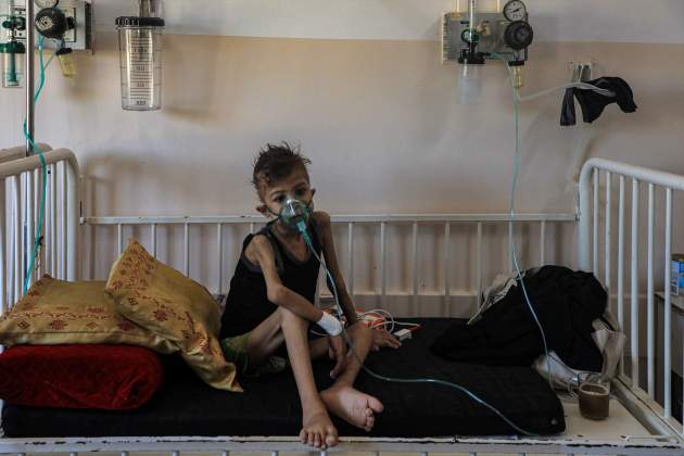 EuropaPress 6871334 gaza july 26 2024 sick palestinian child is seen at the nasser hospital EuropaPress 6871334 gaza july 26 2024 sick palestinian child is seen at the nasser hospital