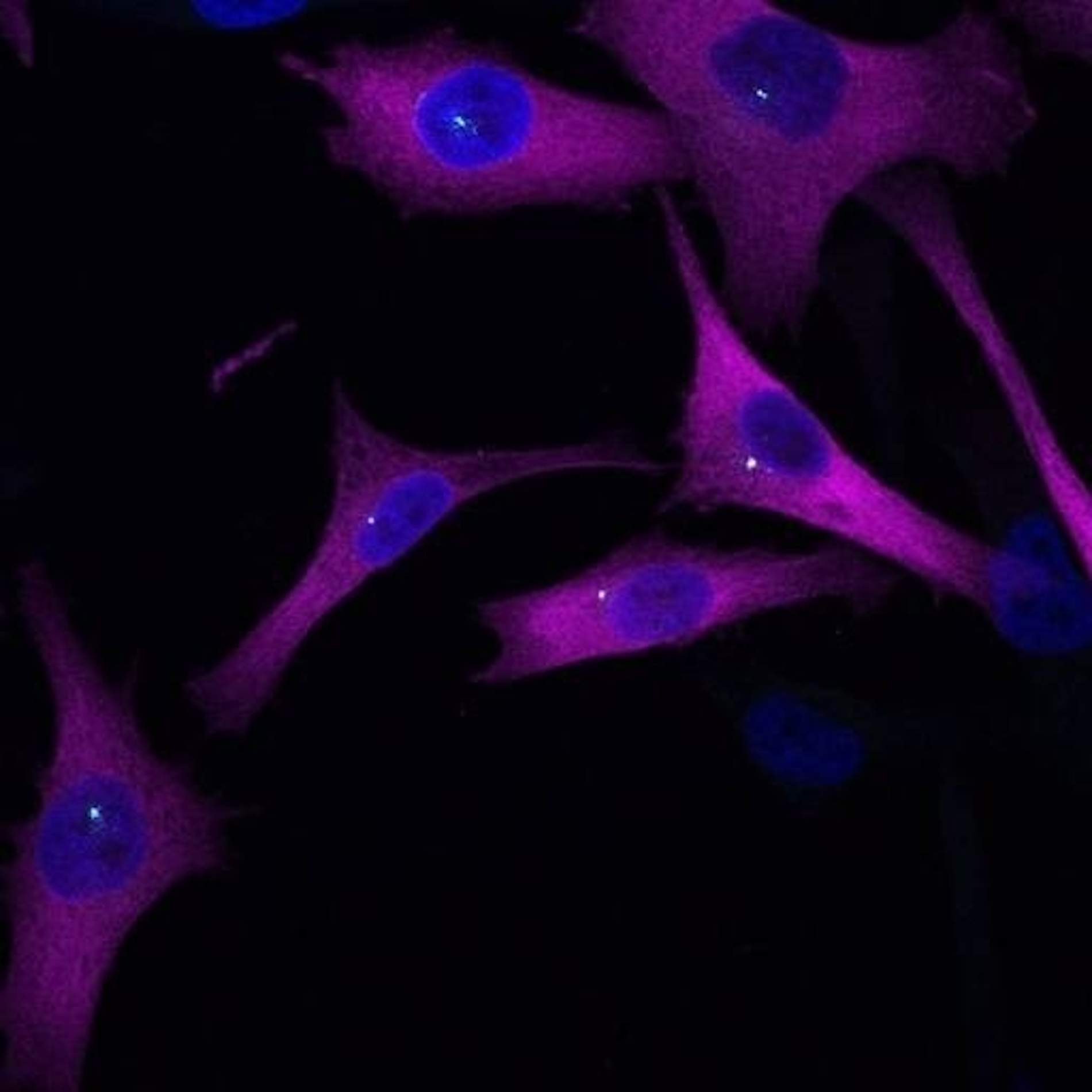 Un estudio catalán descubre un "sistema GPS" del melanoma que podría ayudar a frenar la metástasis