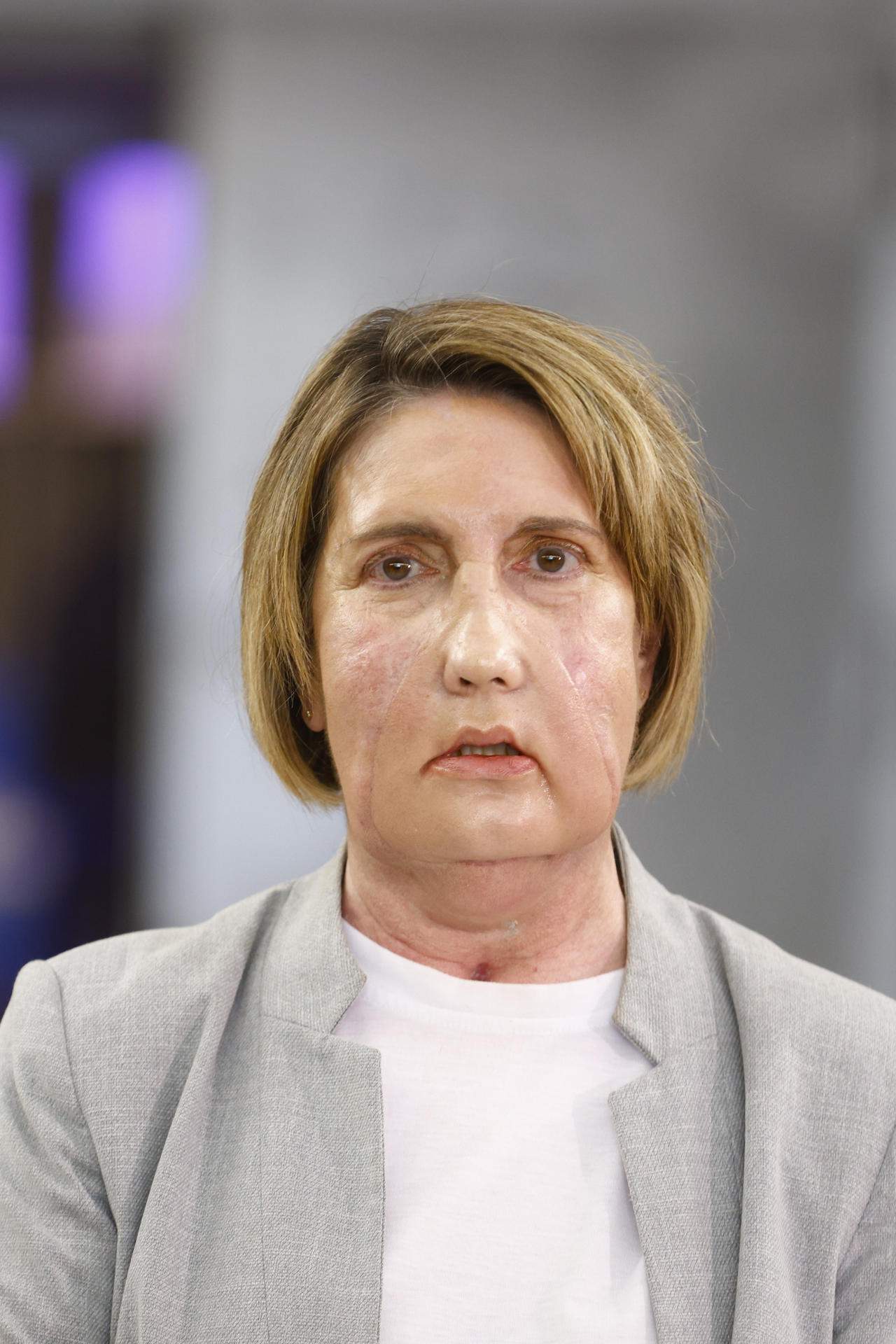 Vall d'Hebron hace el primer trasplante de cara del mundo de una donante que recibió la eutanasia