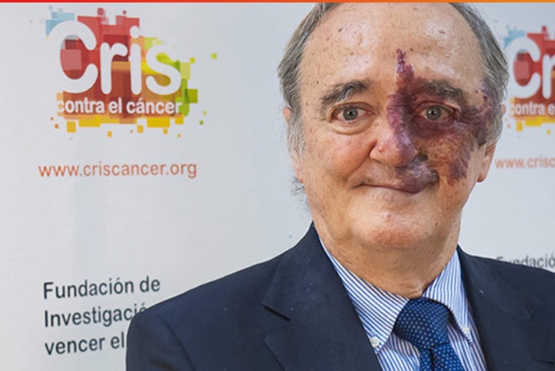 Las falsas expectativas se disparan tras el descubrimiento de Barbacid sobre el cáncer de páncreas