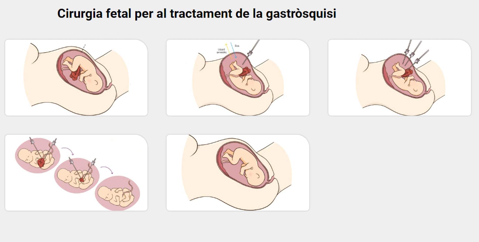 Procés de la intervenció del fetus / Hospital Sant Joan de Déu Procés de la intervenció del fetus / Hospital Sant Joan de Déu