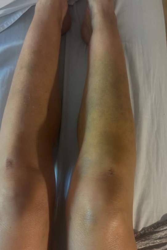 Accident de Lydia Bosch IH Accident de Lydia Bosch IH
