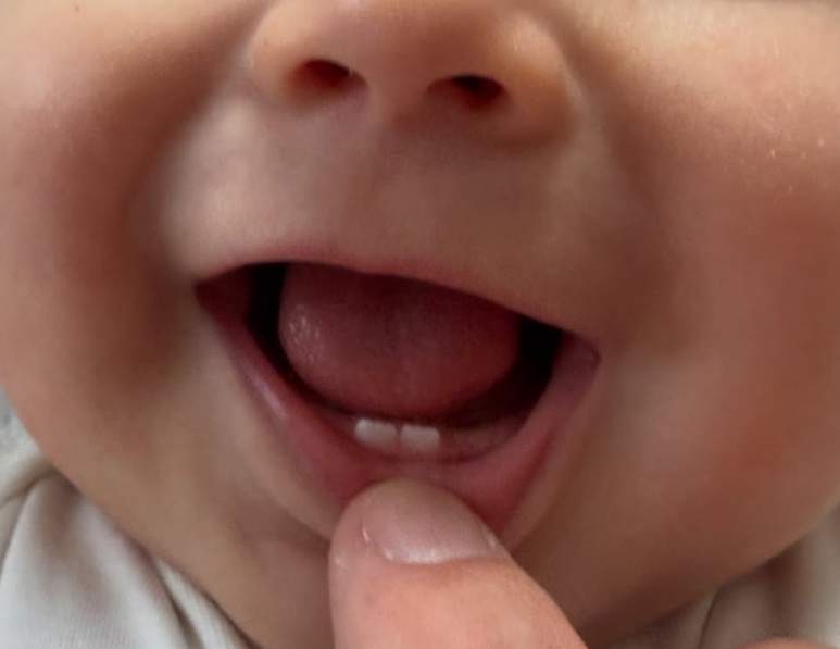 Les dues primeres dents de llet de Dante, Ig Les dues primeres dents de llet de Dante, Ig