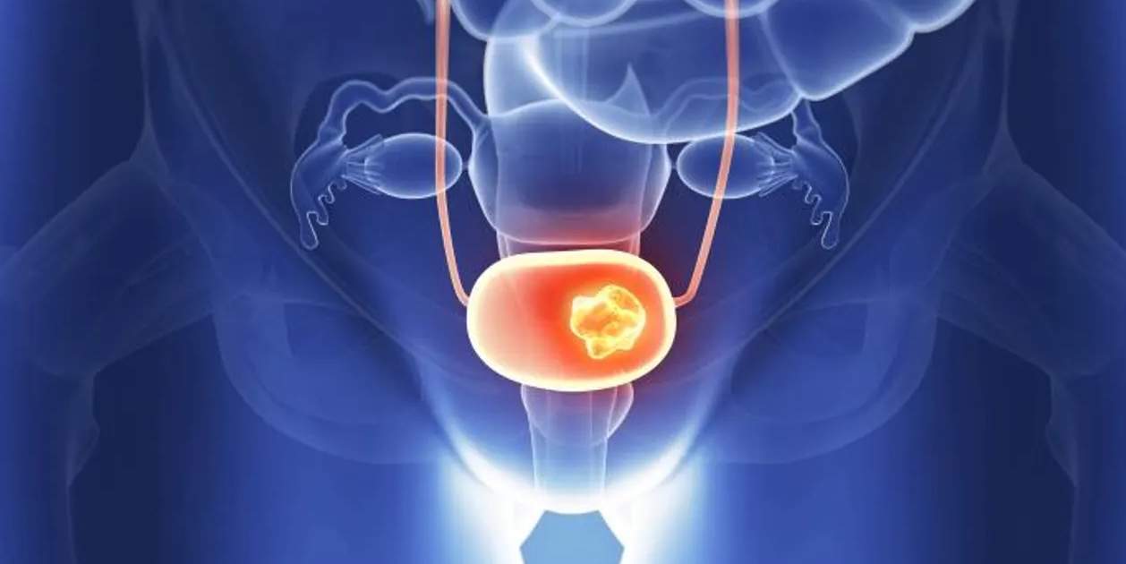 Crean una IA que puede detectar el cáncer de vejiga hasta cinco años antes del diagnóstico
