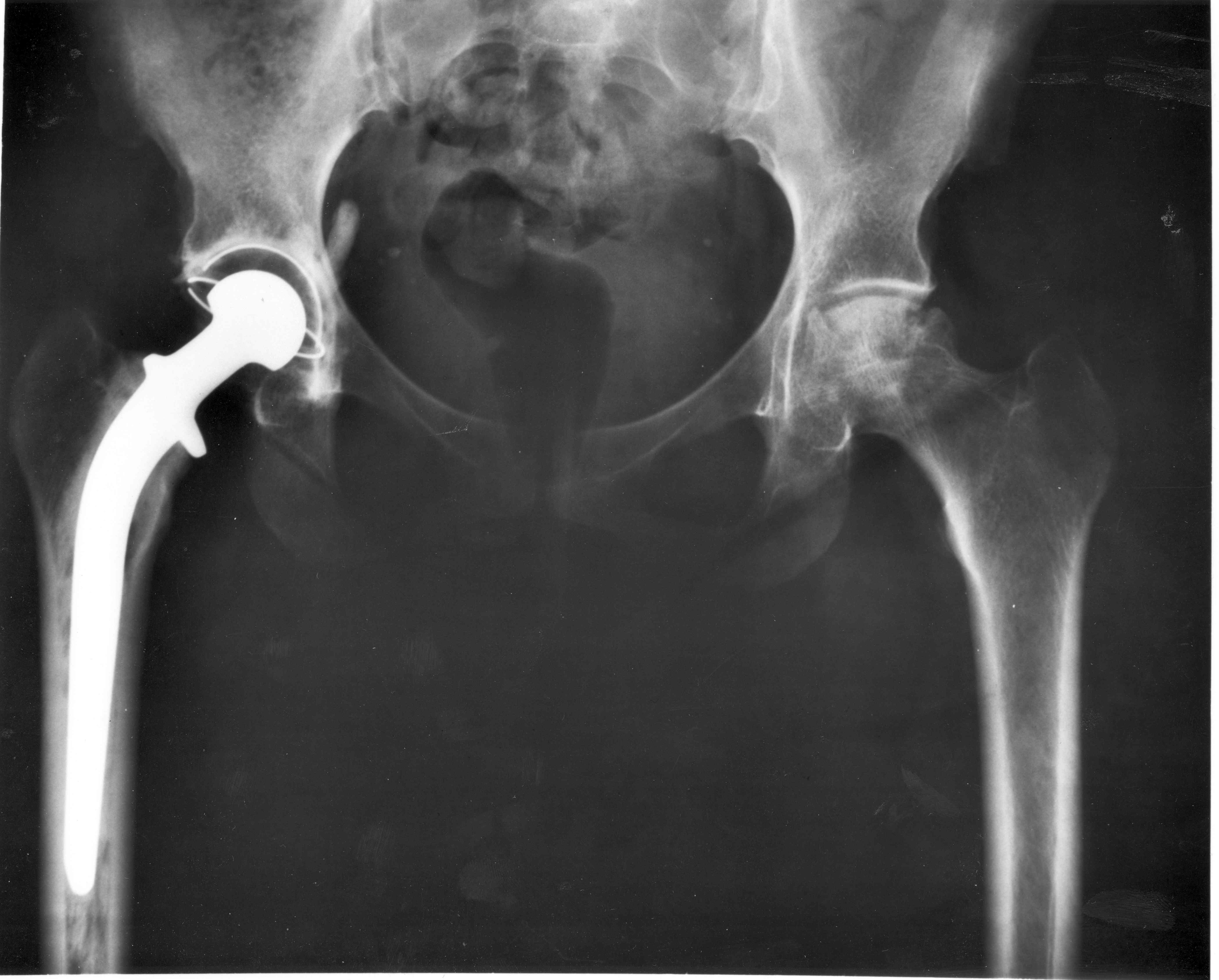Més de 29.000 incidents per pròtesis i implants en mal estat a Espanya en deu anys