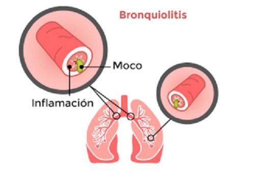 bronquiolitis