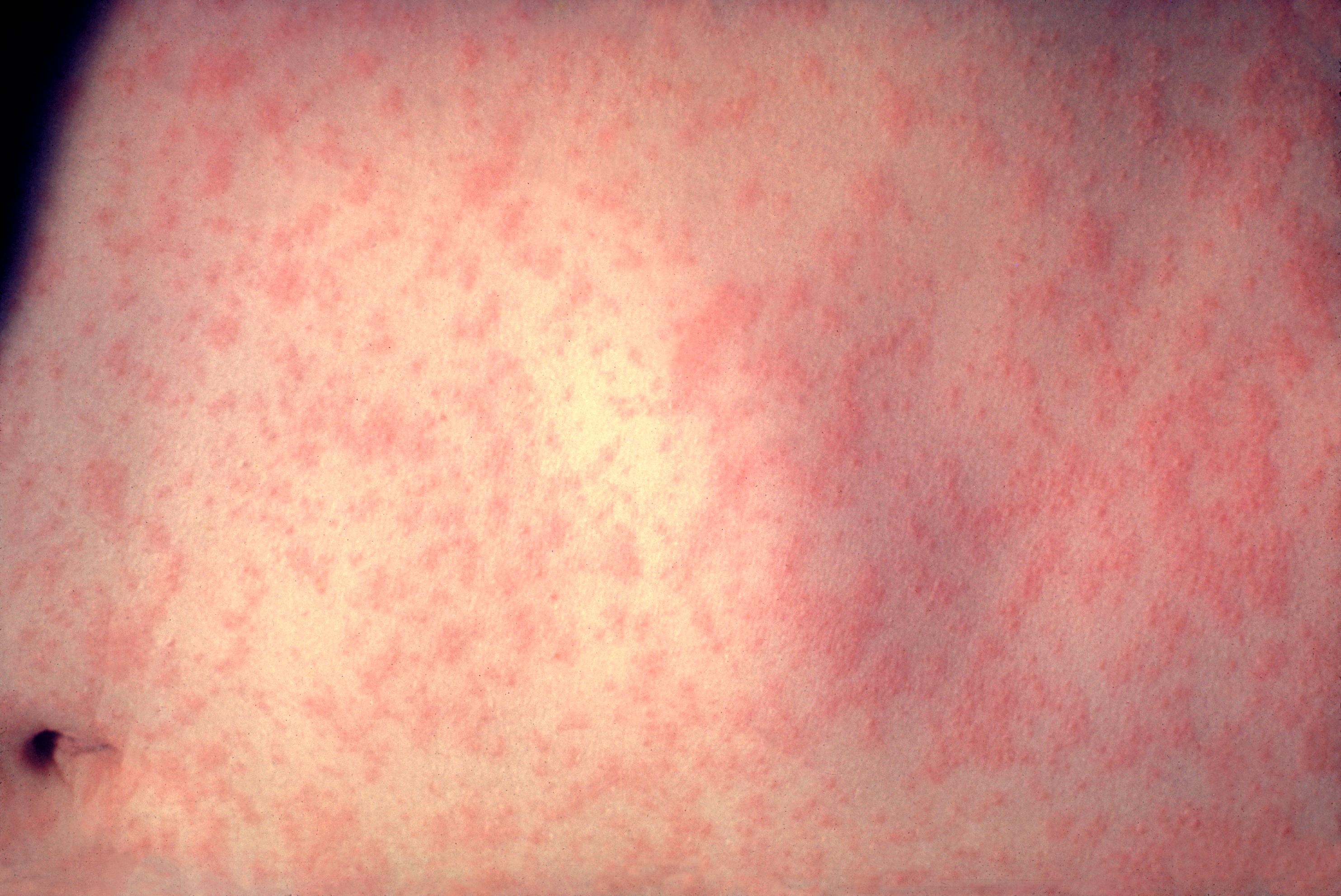 El xarampió triplica la incidència a Europa malgrat que la vacunació augmenta
