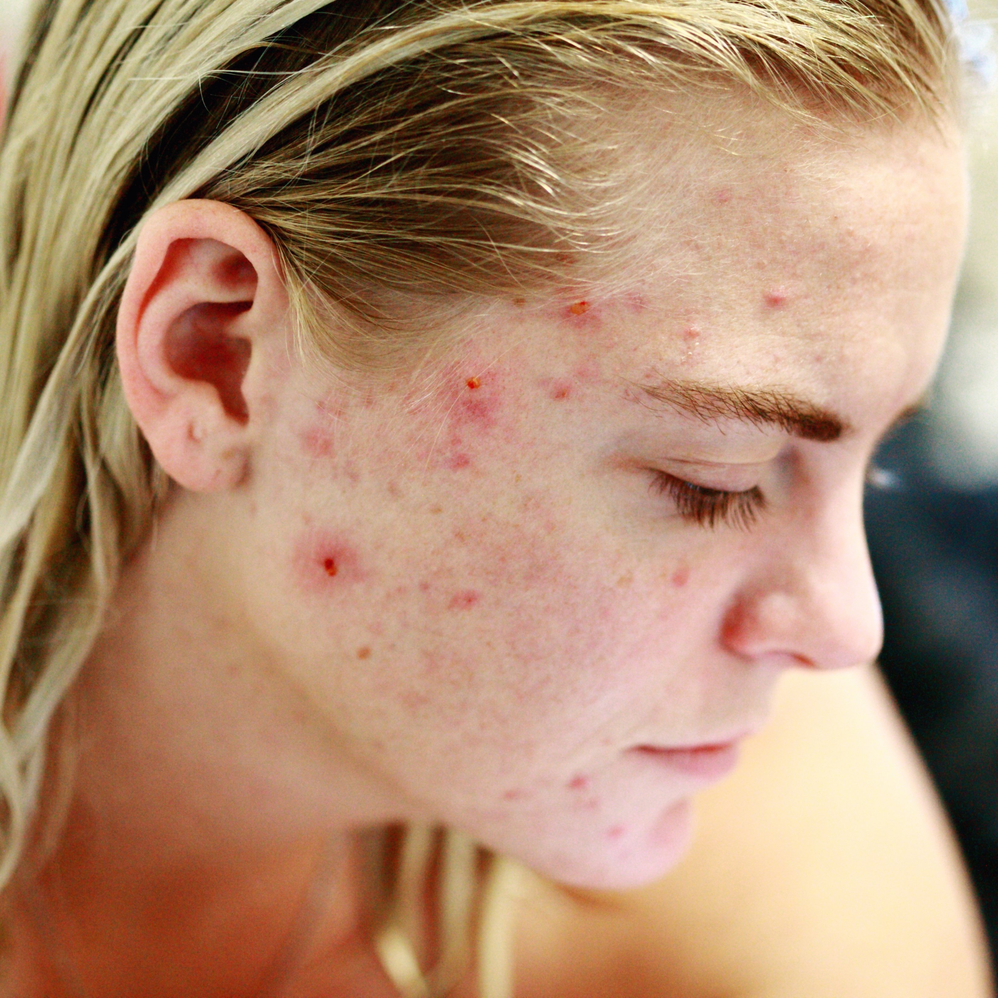 Quines són les causes de l'acne a partir dels 40?