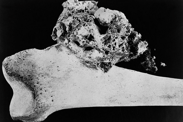 Osteosarcoma de tíbia Viquipèdia