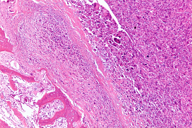 Teixit de l'osteosarcoma