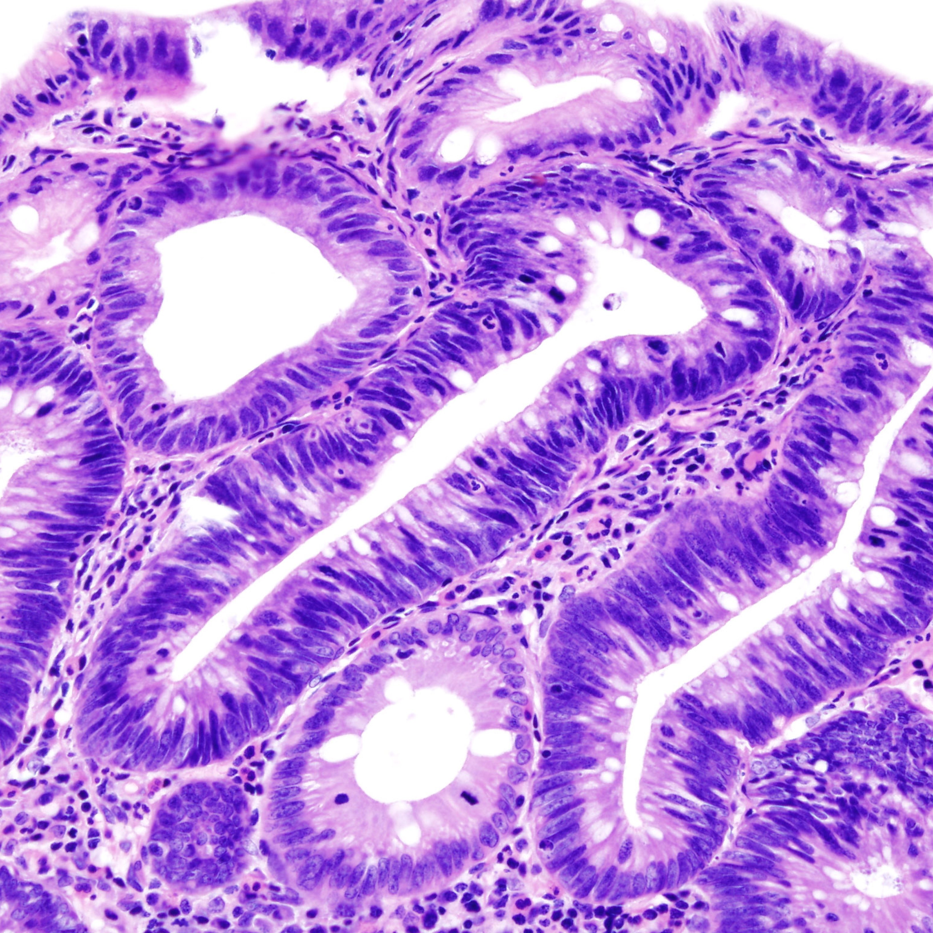 Així són els pòlips adenomatosos, els precursors del càncer de còlon