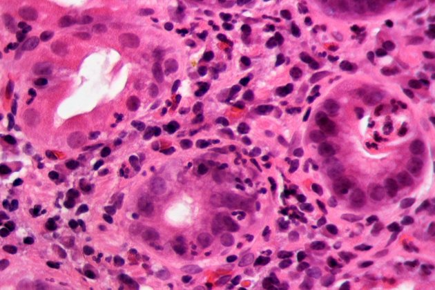 Gastritis por Helicobacter 