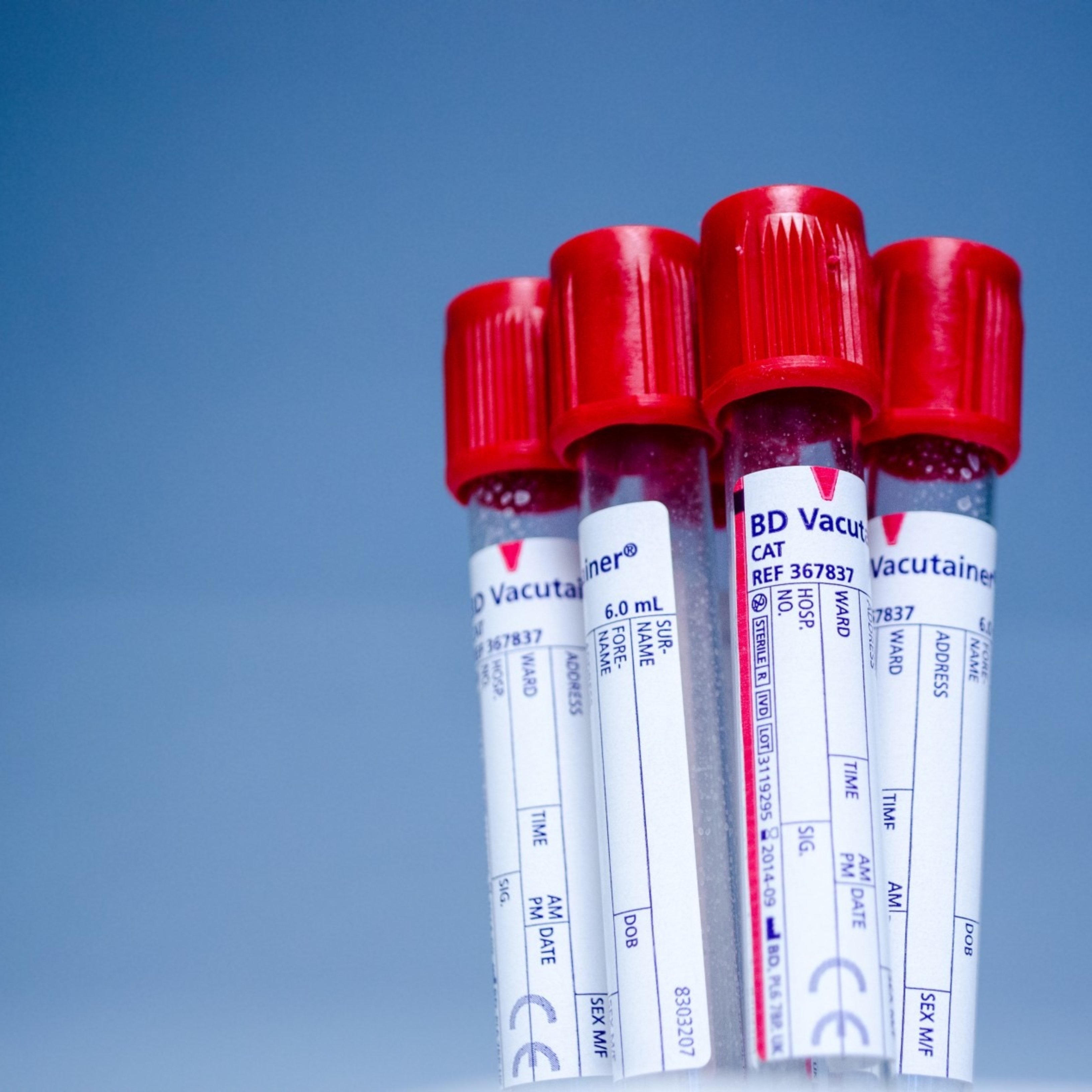 Un nuevo análisis de sangre reduciría el número de biopsias en el cáncer de próstata