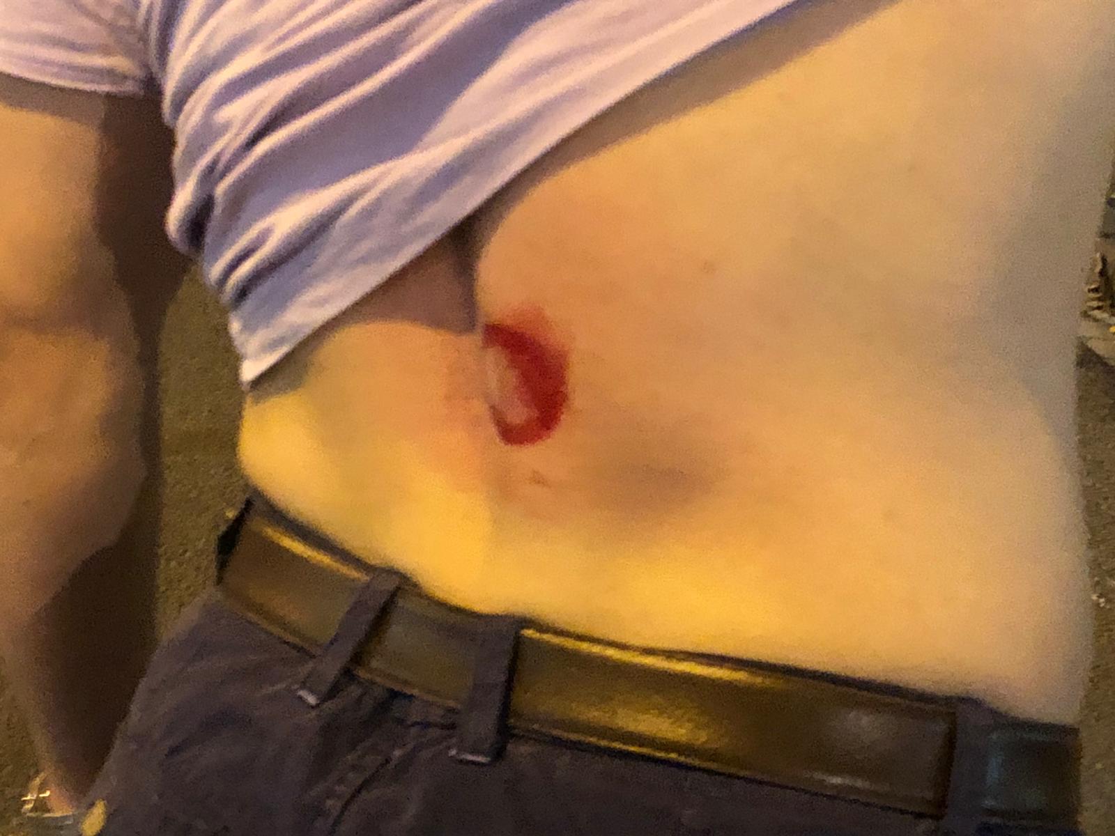 Herido por la policía: "Pasaba por la calle y he recibido un golpe en la espalda"