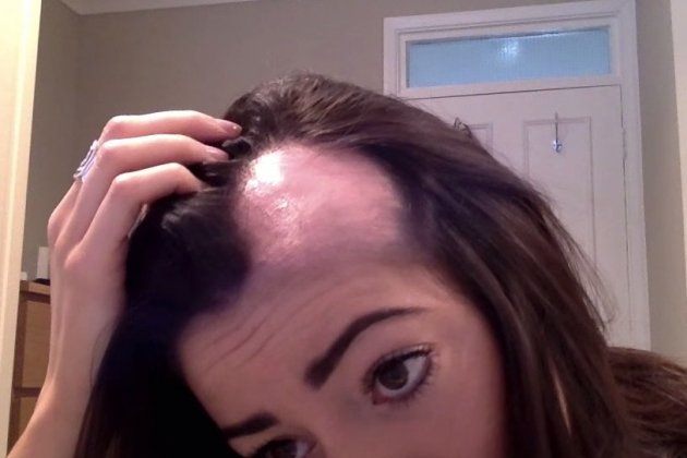 Alopècia femenina