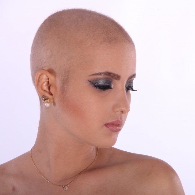 La alopecia se extiende entre las mujeres