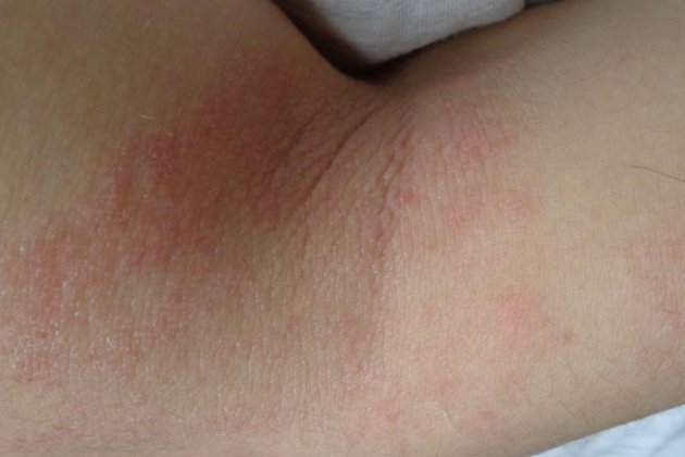 Dermatitis Atópica