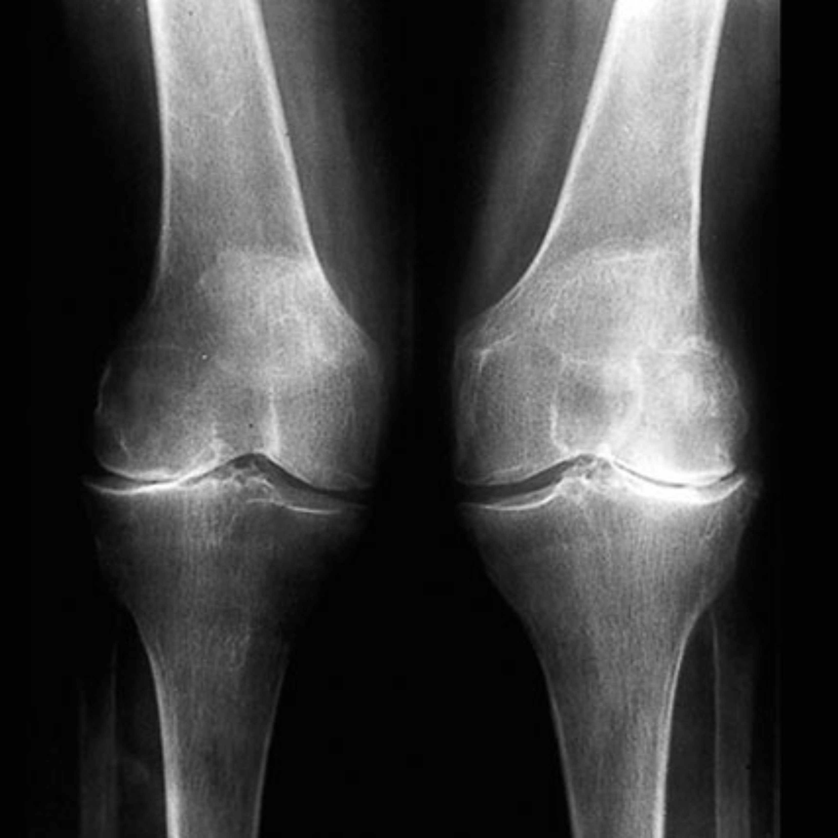 Los síntomas que te pueden indicar que tienes artrosis en la rodilla