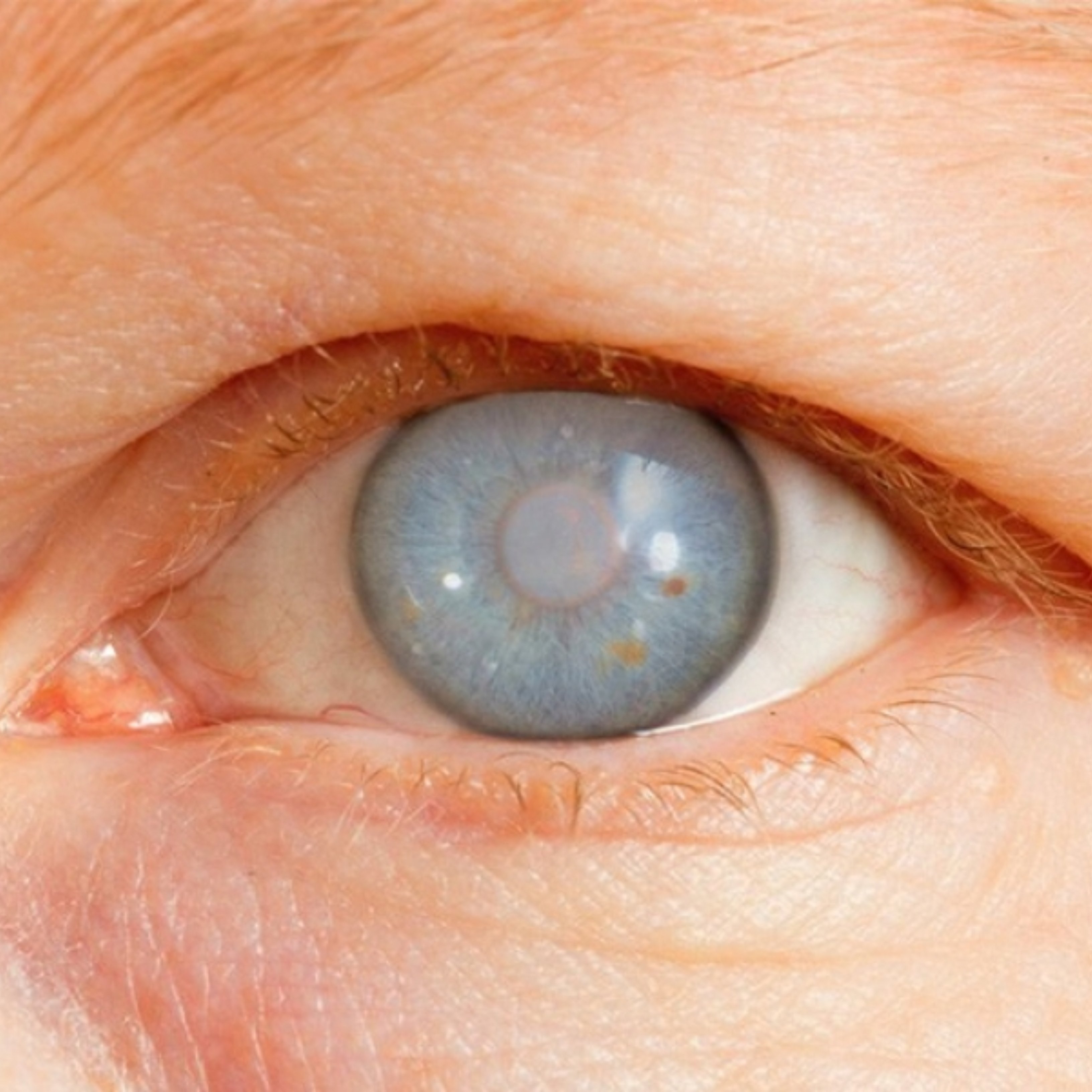 Signes que pots estar patint glaucoma