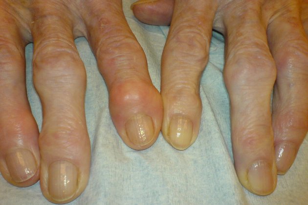 Dedos artrosis