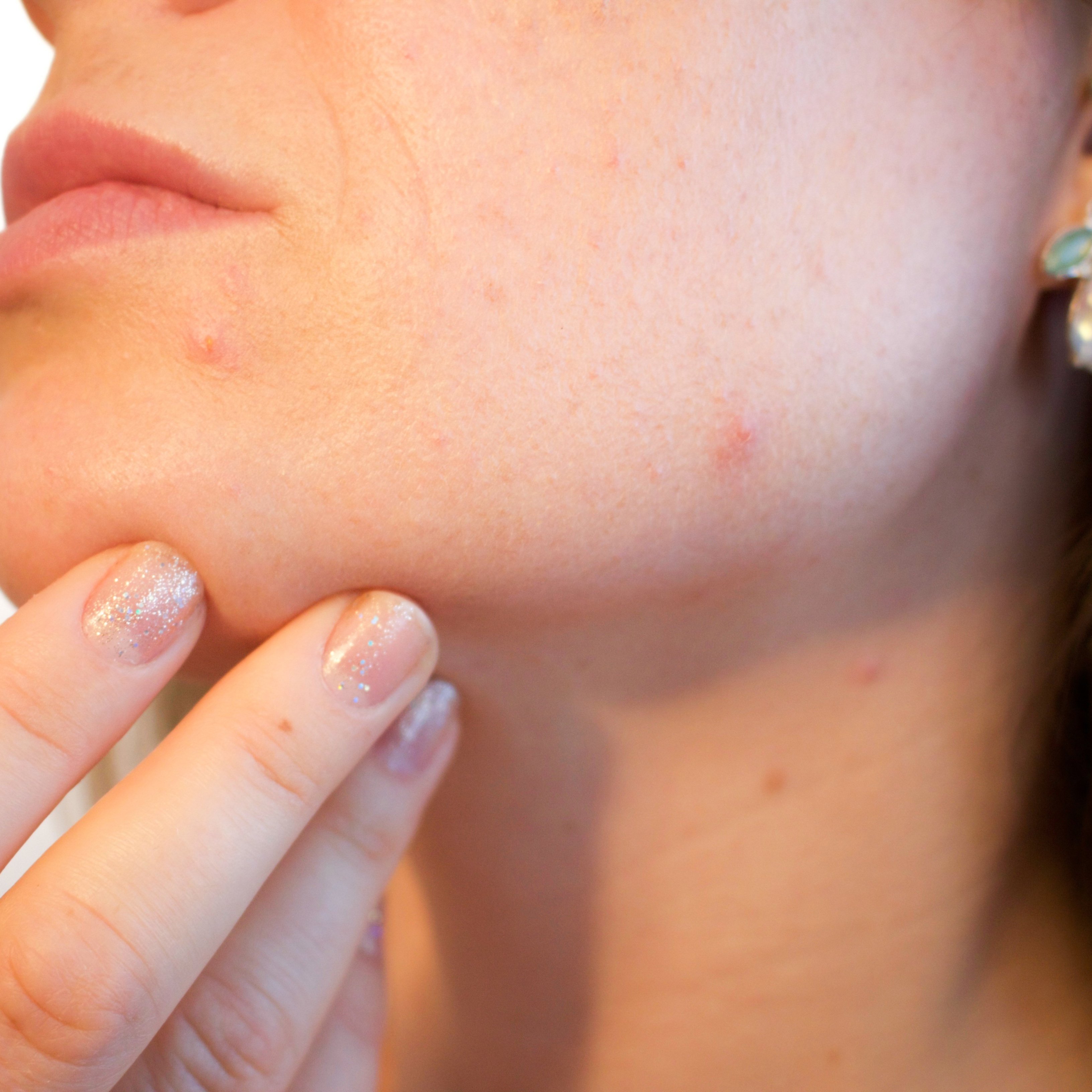 Set consells per evitar l'acne en la vida adulta